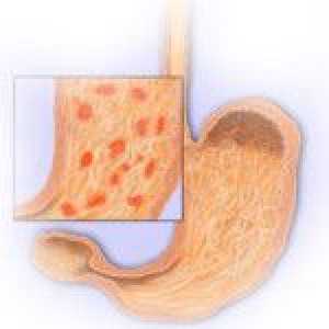Kronični erozivni gastritis, njeni simptomi in pomoč prehrana pri zdravljenju