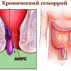 Kronične (konstanta), notranji in zunanji hemoroidi