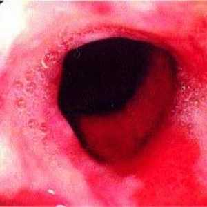 Ulcerozni ezofagitis požiralnika