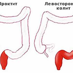 Ulcerozni kolitis je oblika distalnega