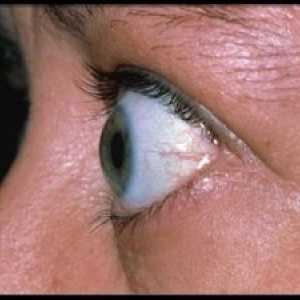 Endokrina oftalmopatija: zdravljenje, simptomi, diagnostika, klasifikacija