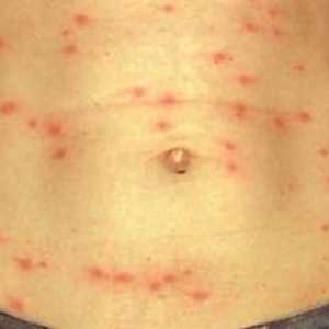 Epidemija tifus: preprečevanje, patogen, vzroki, diagnoza