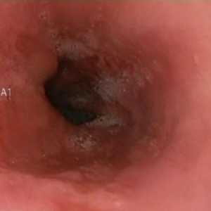 Erozivni refluksnega ezofagitisa in gastritisa