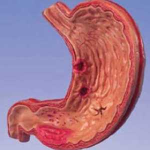 Etiologija kronične gastritis