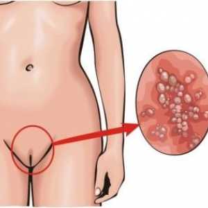 Candida vaginitisa: zdravljenje, simptomi, vzroki, simptomi