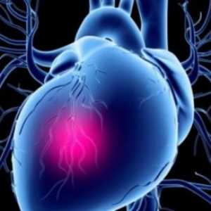 Kardiogeni šok: zdravljenje, simptomi, vzroki, simptomi