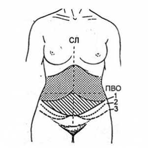 Klasična abdominoplasty