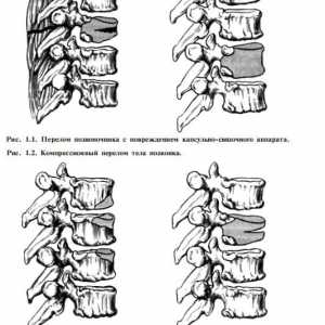 Klasifikacija poškodb hrbtenice in hrbtenjače