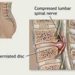 Kompresijo hrbtenjače (sindrom): Simptomi, Zdravljenje