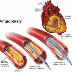 Koronarno angioplastiko