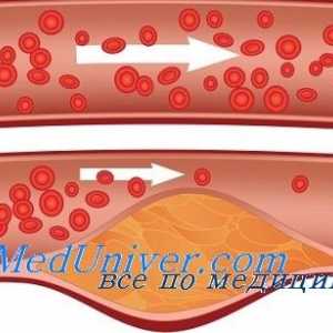 Dermalne krvnih žil v sladkorno boleznijo. Mikroangiopatije pri sladkorni bolezni