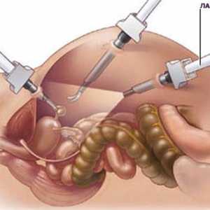 Laparoskopija trebušne slinavke v pankreatitis