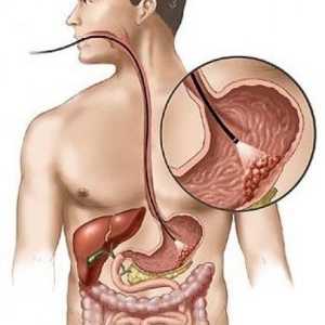 Limfom želodca in debelega črevesa: zdravljenja Pronoza, znaki, simptomi, vzroki