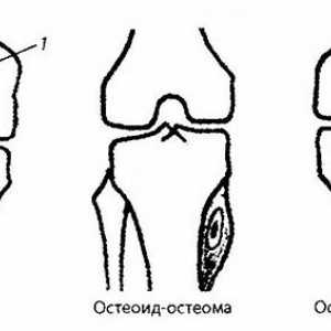 Sevanje in instrumentalne diagnoza kolenskega sklepa patologije. Tumor kolenskega sklepa