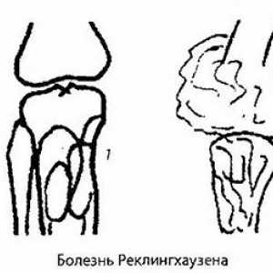 Sevanje in instrumentalne diagnoza kolenskega sklepa patologije. artritis