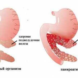 Pankreatitis povzročene z zdravili