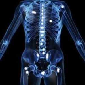 Metastazami v kosteh: zdravljenje, prognoza, simptomi, znaki, diagnoza