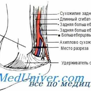 Postopek tibialis posterior arterije kateterizacijo s izolacije