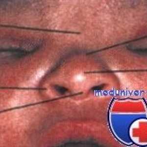 Načini odstranjevanje nosnega septuma premik pri novorojenčkih