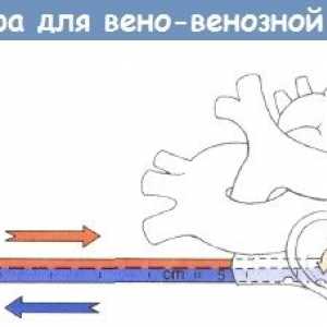 Postopek veno-vensko kateterizacijo za zunajtelesni membranski oksigenaciji (ECMO)