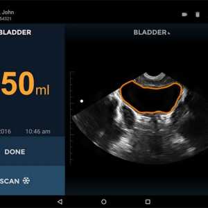 Miniaturni ultrazvok skener za urologi