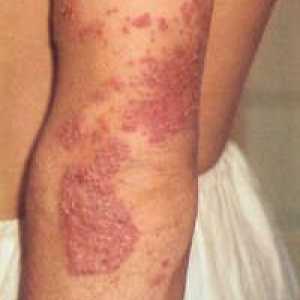 Miniatlas: kožne bolezni spremlja srbenje