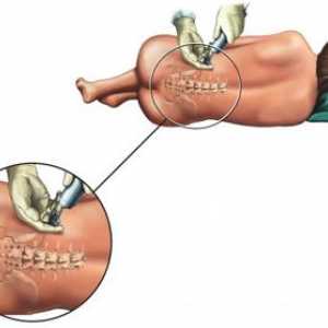 Anestezijo in epiduralne anestezije med operacijo odstraniti hemoroide