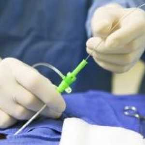 Kršitev spermatogeneze: vzroki, zdravljenje
