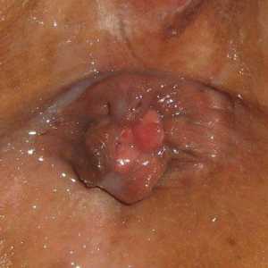 Zunanji hemoroidi fringe po odstranitvi hemoroide