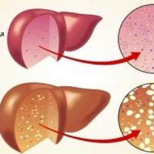 Brezalkoholne maščobne bolezni jeter: Zdravljenje