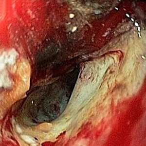 Raznovrstna rak želodca in njegova prognoza