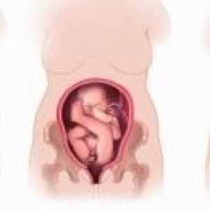 Napačen položaj in predstavitev plod med nosečnostjo