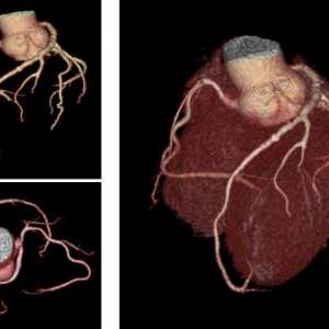 Novi CT skener za arineta ospredje ct srcu bo šel na kliniko v ZDA