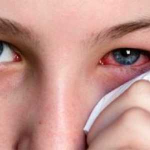 Ophthalmoherpes: zdravljenje, simptomi