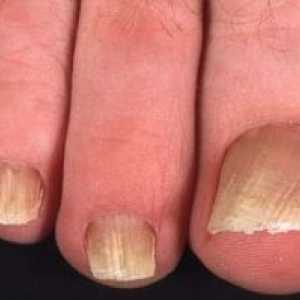 Onihomikoza Nails: zdravljenje, simptomi, diagnosticiranje, vzroki, preprečevanje, simptomi