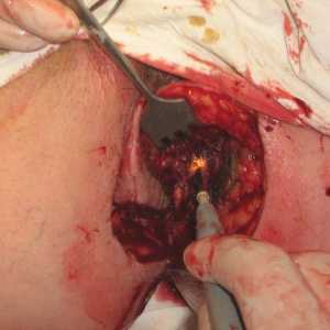 Kirurška odstranitev hemoroide in analne razpoke