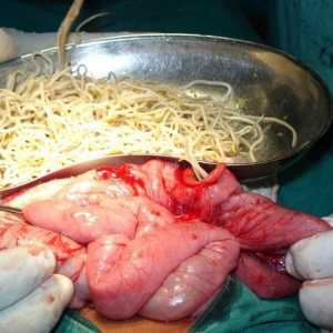 Kirurška odstranitev črvov, kako odstraniti paraziti?