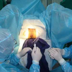 Kirurška odstranitev zunanjosti (zunaj) hemoroide