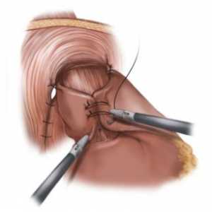 Kirurško zdravljenje refluksnega ezofagitisa in fundoplication