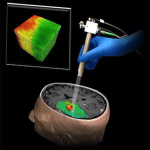 Optična sonda za odstranitev možganskega tumorja