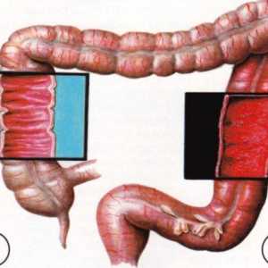 Zapleti ulceroznem kolitisu
