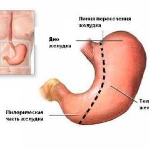 Zapleti želodca resekcijo in želodca