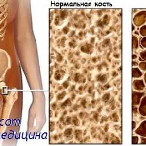 Osteomalacija. Osteoporoza in karakterizacija osteoporoze