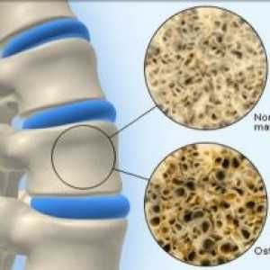 Osteoporoza Bone: zdravljenje, simptomi, vzroki, simptomi, preprečevanje, odkrivanje