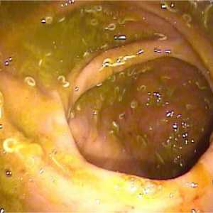 Glist v črevesju, anus, anus črevesja enterobiosis
