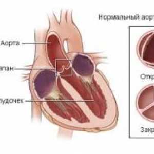 Akutna disfunkcija srčnih zaklopk