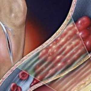 Akutna tromboza globokih ven spodnjih okončin: zdravljenje, simptomi