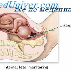 Uhelj in rojstvo placente. Bolečina med porodom
