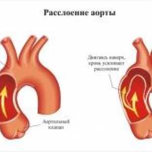 Aortna patologija v nosečnosti