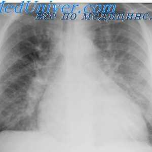 Akutni pljučni edem. Pljučni edem začaran krog